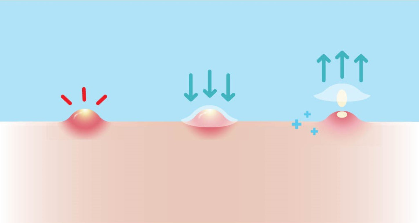 Graphics of Pimple Patch process